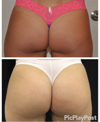 Sculptra Butt Lift