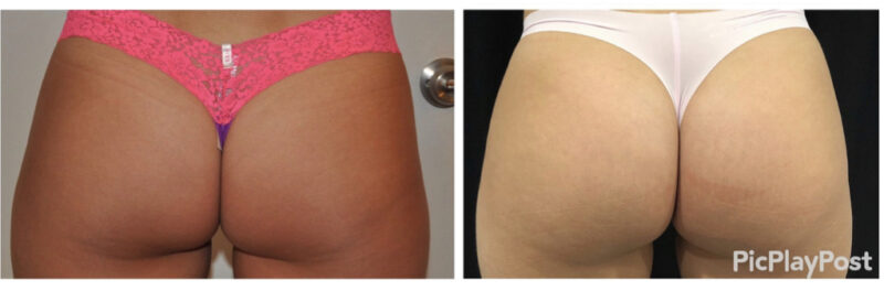 Sculptra Butt Lift