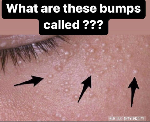 what are these bumps called?