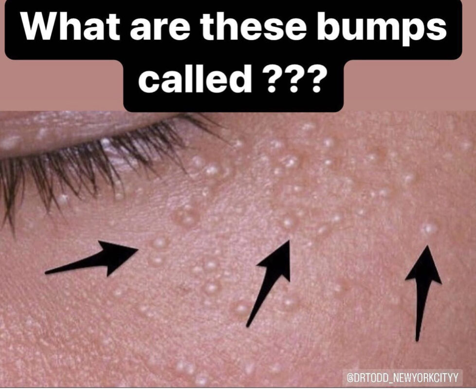 what are these bumps called?
