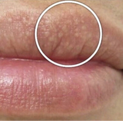 What are these bumps on her lips?